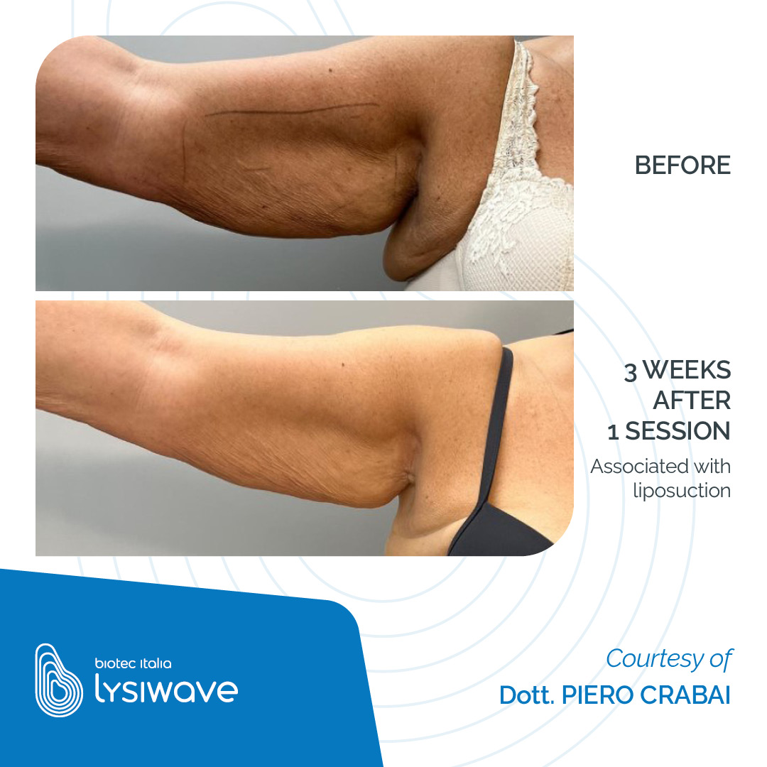 LYSIWAVE_Before-After_01