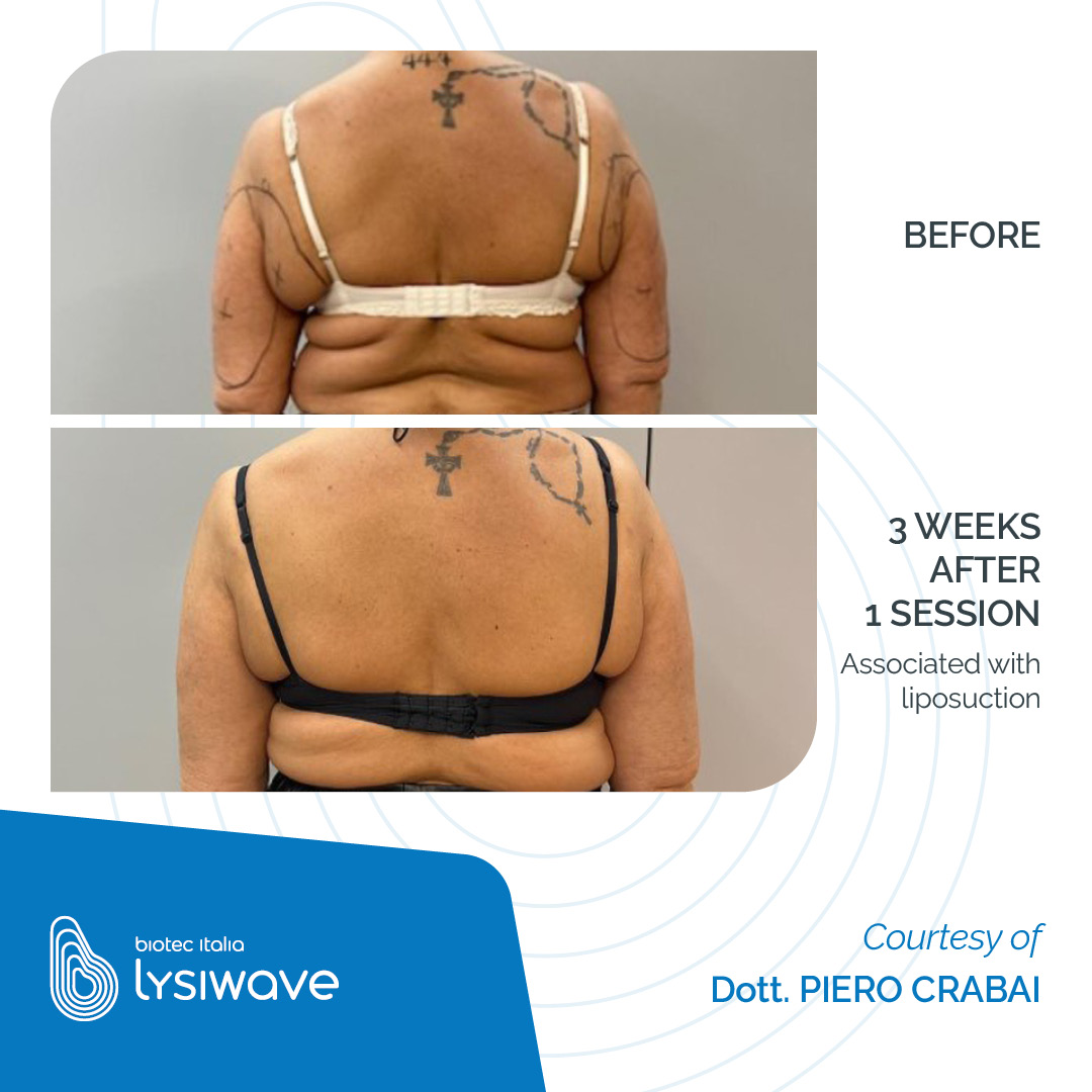 LYSIWAVE_Before-After_02