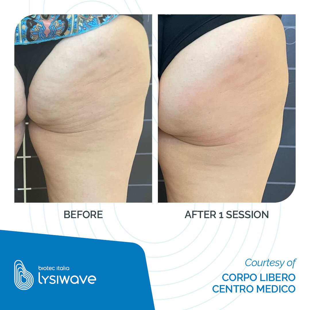 LYSIWAVE_Before-After_05